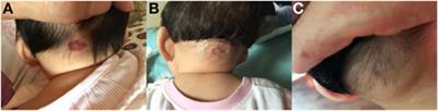 Topical Application of 0.5% Timolol Maleate Hydrogel for the Treatment of Superficial Infantile Hemangioma